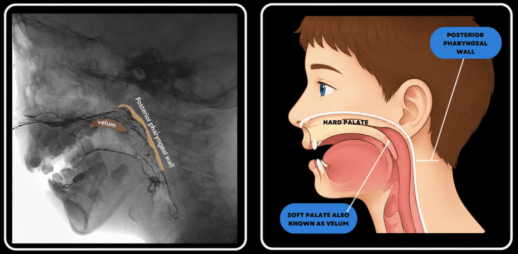Lateral view on a velopharyngeal videofluoroscopy and illustration