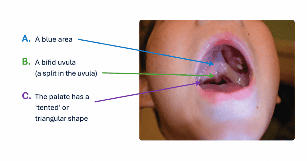 other cleft palate signs