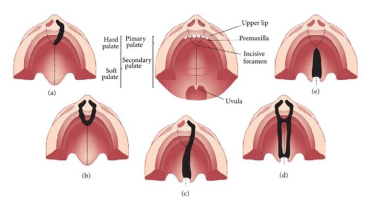 illustration of all types of cleft palate